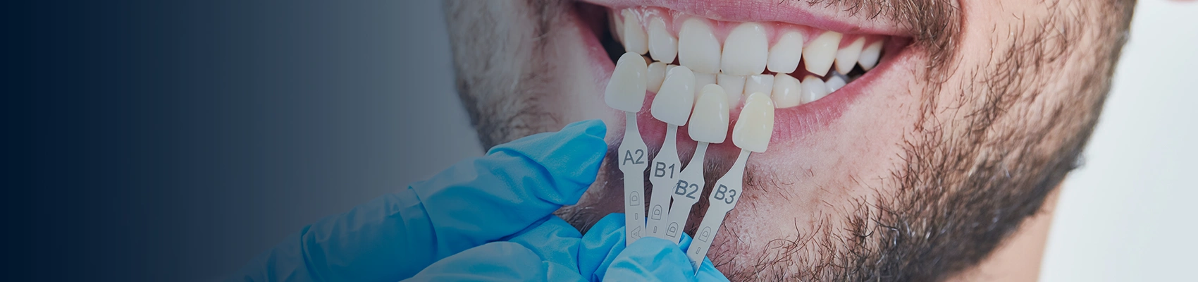 What are the Advantages of Dental Veneers