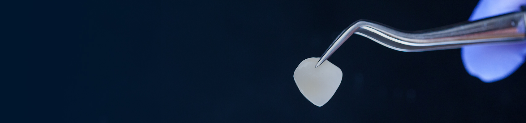 Alternative Option to A Dental Crown Banner 