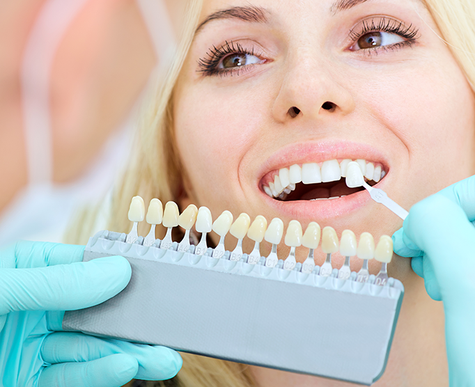 What Are The Advantages of Dental Vebeers?