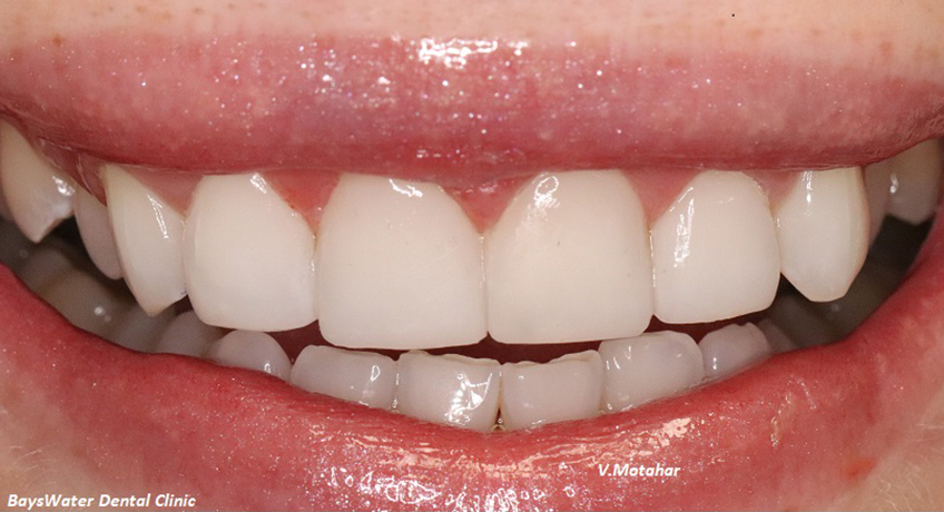 Composite Veneers After Image - Bayswater Dental Clinic
