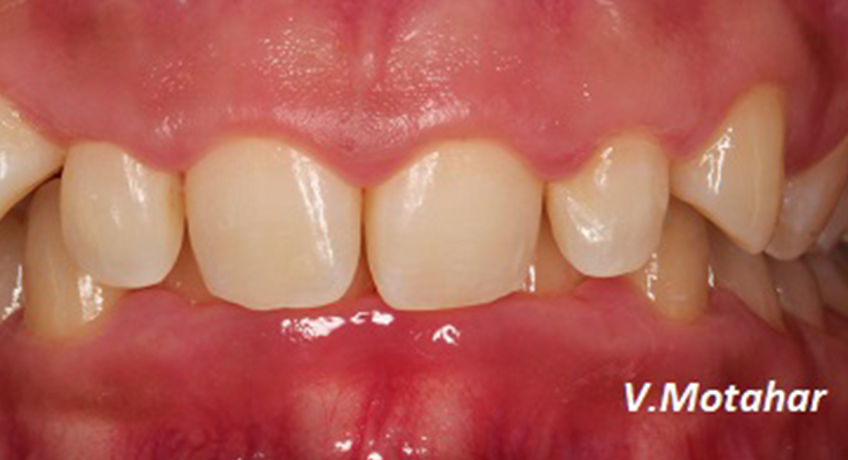 Gum Contouring Before 2 Image - Bayswater Dental Clinic