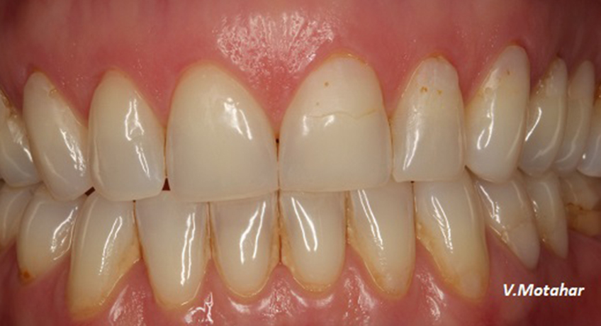 Gum Contouring After 3 Image - Bayswater Dental Clinic