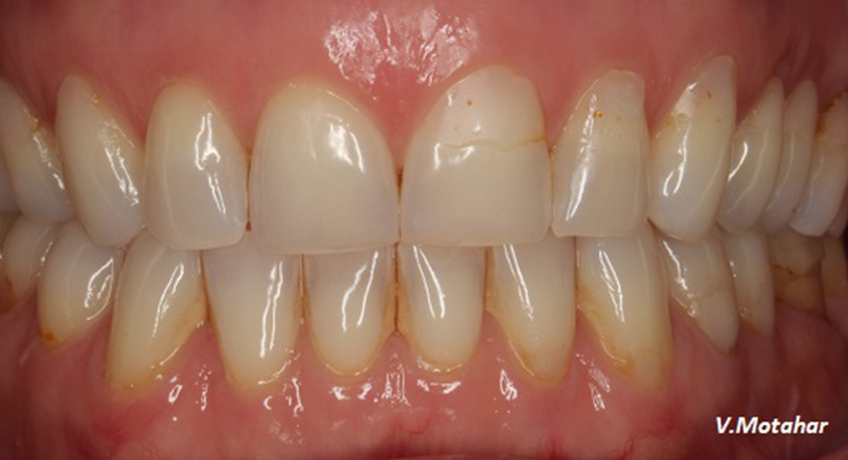 Gum Contouring Before 3 Image - Bayswater Dental Clinic