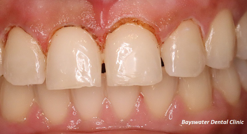 Gum Contouring After Image - Bayswater Dental Clinic