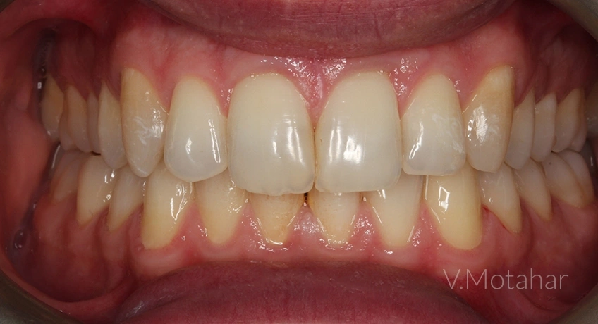Invisalign i7 After Image – Bayswater Dental Clinic
