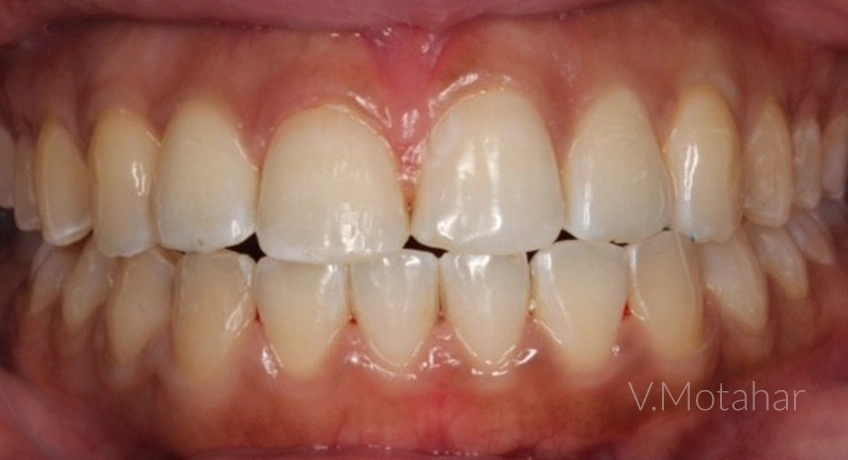 Invisalign Lite After Image – Bayswater Dental Clinic