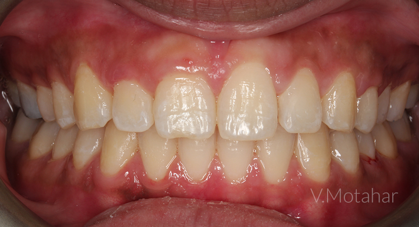 Invisalign Lite 2 After Image – Bayswater Dental Clinic