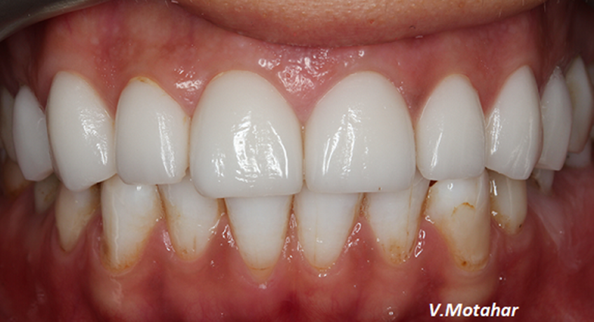 Porcelain Veneers After 2 Image - Bayswater Dental Clinic