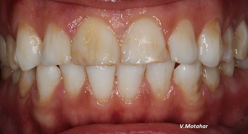 Porcelain Veneers Before 2 Image - Bayswater Dental Clinic