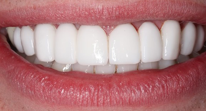 Porcelain Veneers After 3 Image - Bayswater Dental Clinic