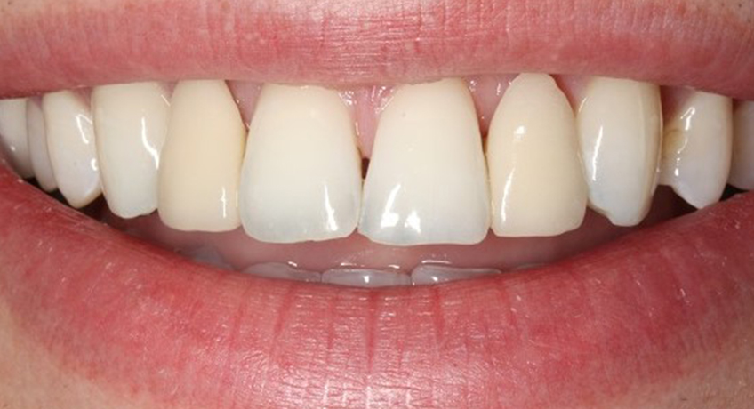 Porcelain Veneers Before 3 Image - Bayswater Dental Clinic