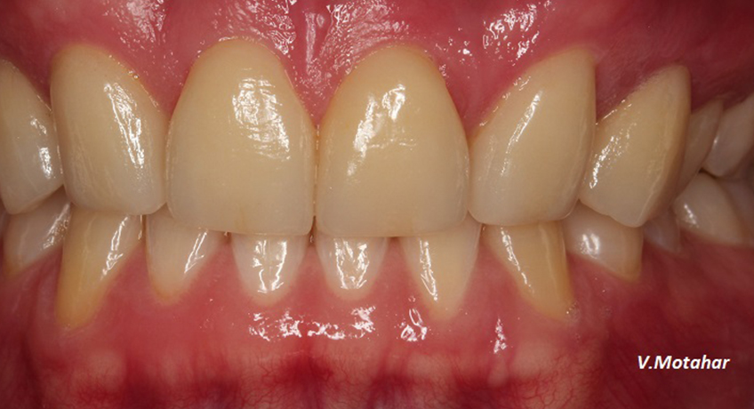 Porcelain Veneers After Image - Bayswater Dental Clinic