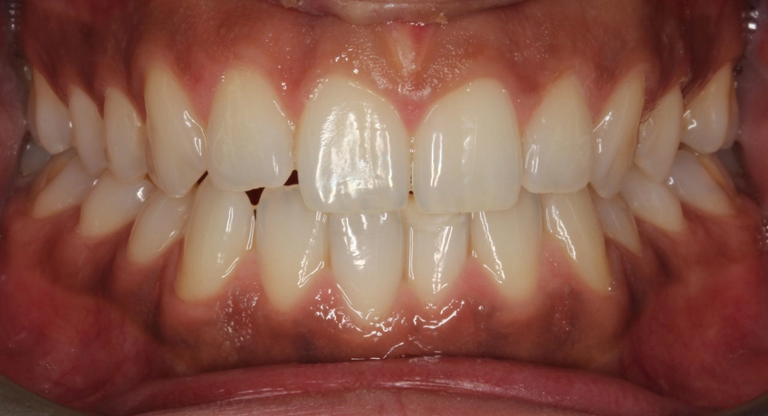 Six Month Smiles Before 2 Image - Bayswater Dental Clinic