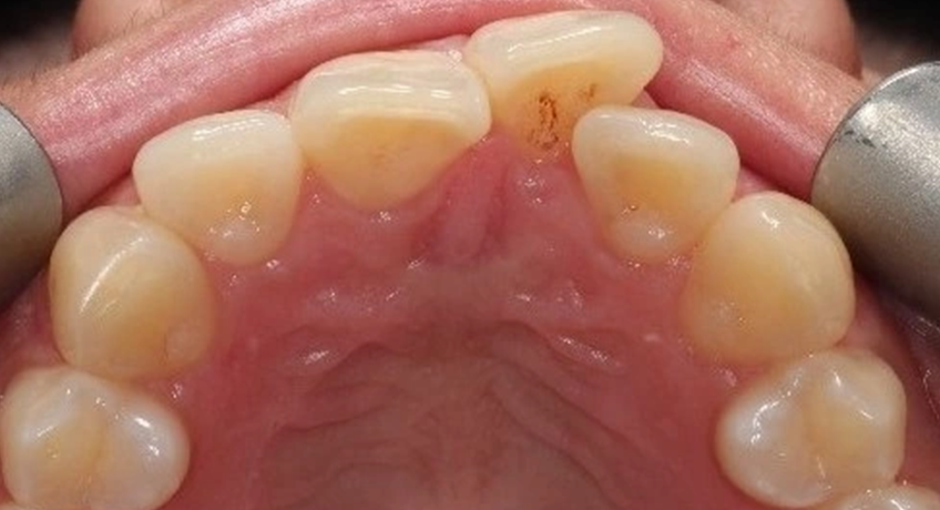Six Month Smiles Before 3 Image - Bayswater Dental Clinic