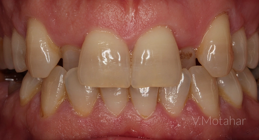 Six Month Smiles Before Image - Bayswater Dental Clinic