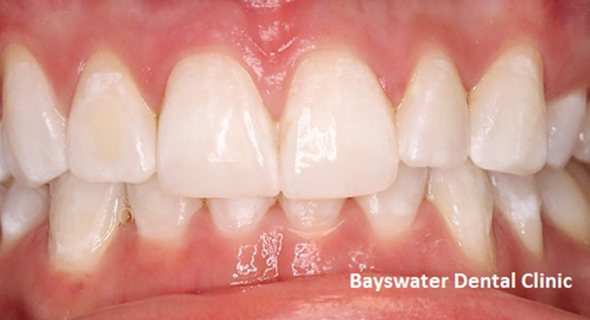 Teeth Whitening After 2 Image - Bayswater Dental Clinic