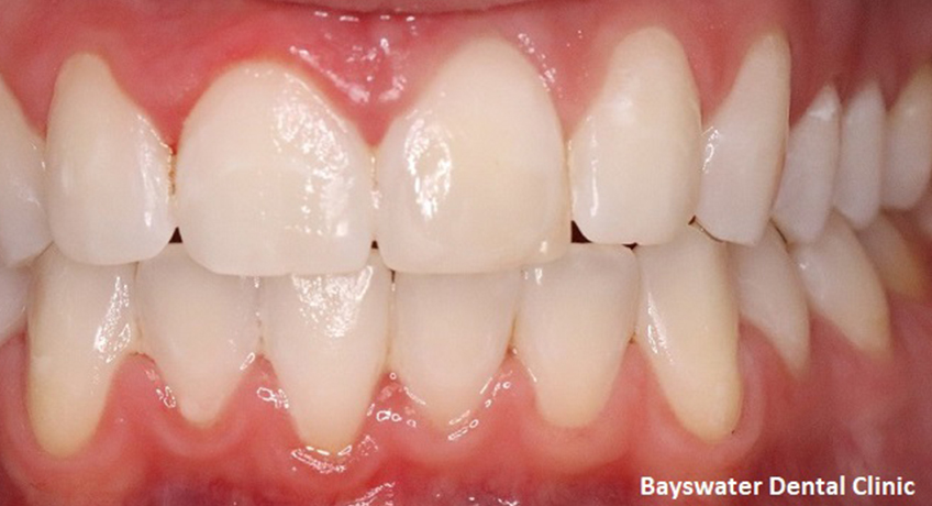 Teeth Whitening After 3 Image - Bayswater Dental Clinic