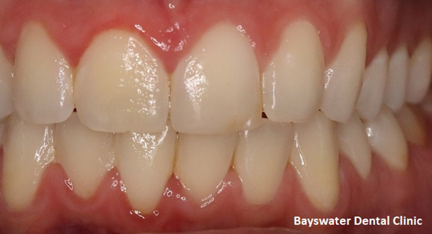 Teeth Whitening Before 3 Image - Bayswater Dental Clinic