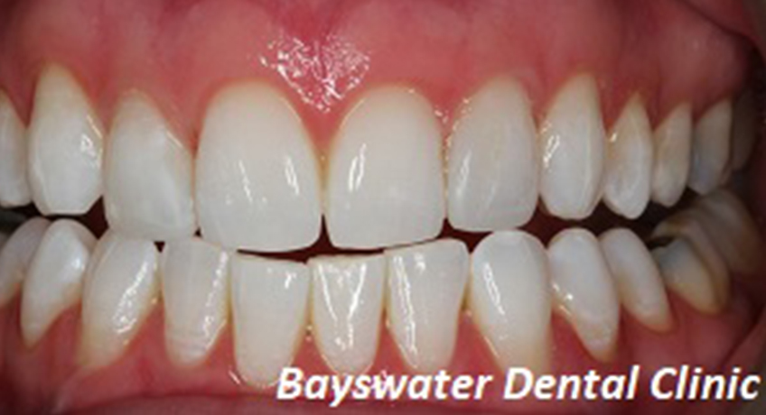 Teeth Whitening After Image - Bayswater Dental Clinic