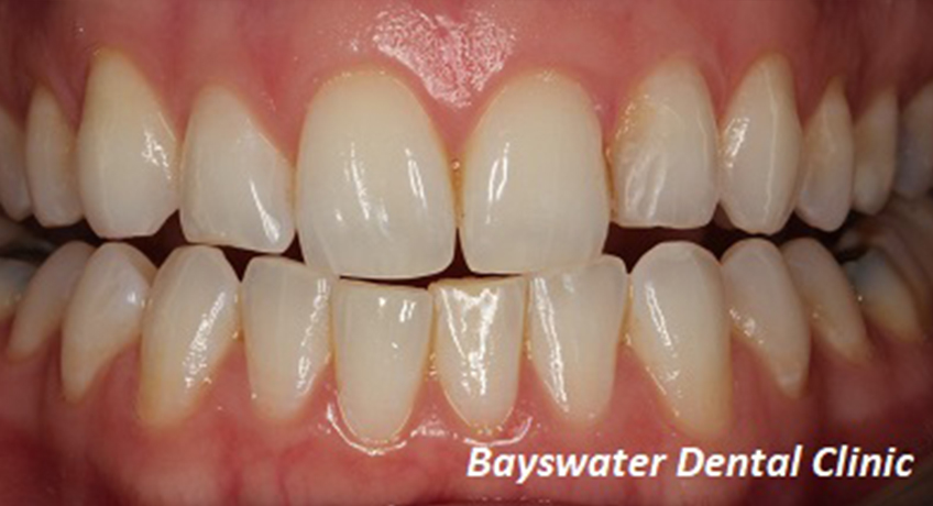Teeth Whitening Before Image - Bayswater Dental Clinic