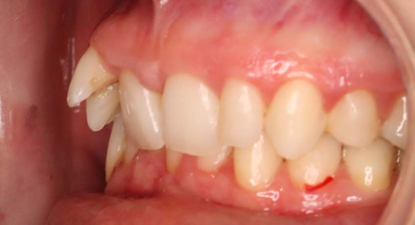 Before using Invisalign with Special Offers