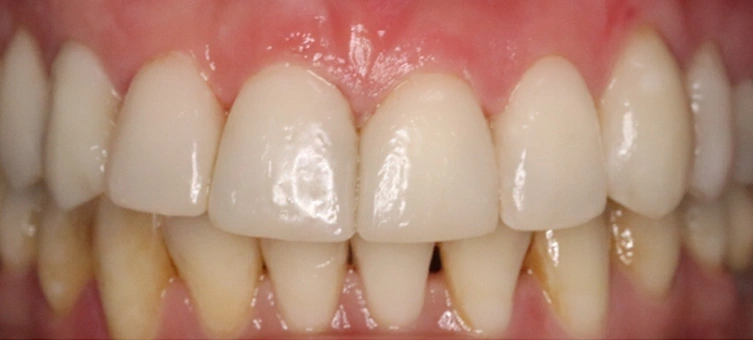 Composite Bonding After Image