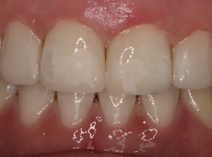 Composite Bonding Treatment After image