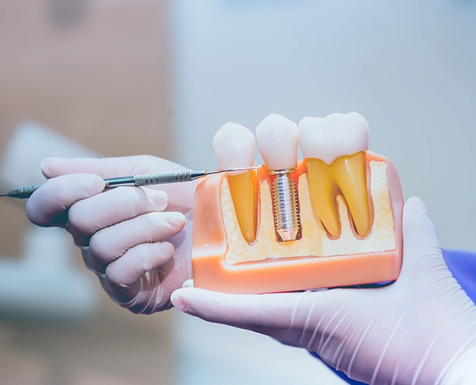 Cost of Dental Crown treatment in London - Bayswater Dental Clinic