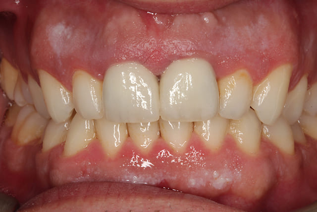 Dental Crown after image at Bayswater Dental Clinic