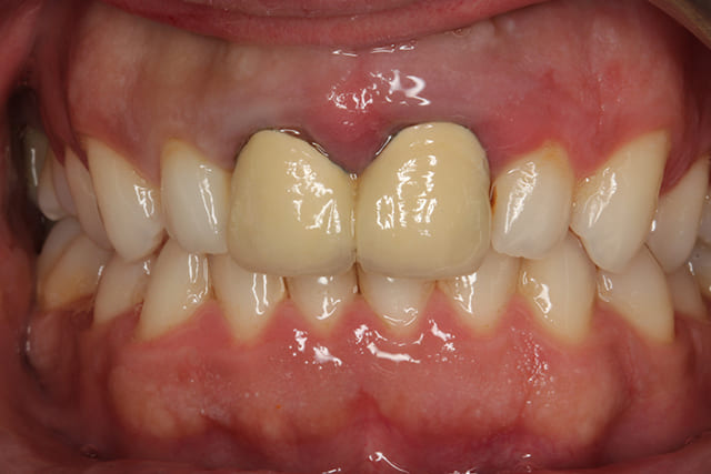 Dental Crown before image at Bayswater Dental Clinic