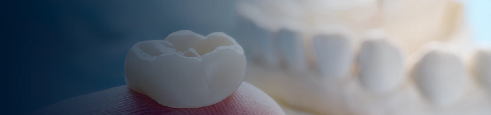 Dental Crowns at Bayswater Dental Clinic banner image