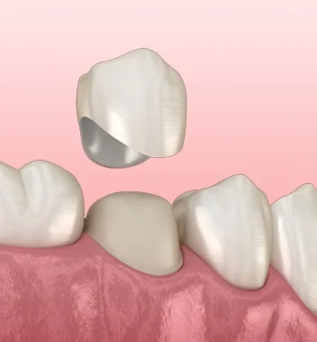 Dental Crown London - Bayswater Dental Clinic