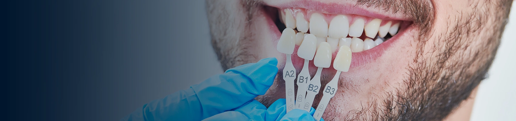 Do Porcelain Veneers Break? - Bayswater Dental Clinic banner image