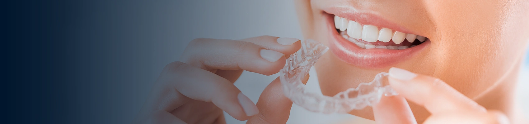 How Long To Wear The Clear Braces – Bayswater Dental Clnic 
