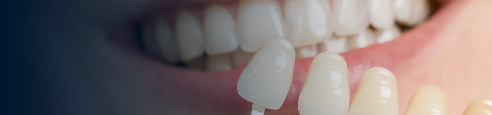 Dental Veneers Banner Image