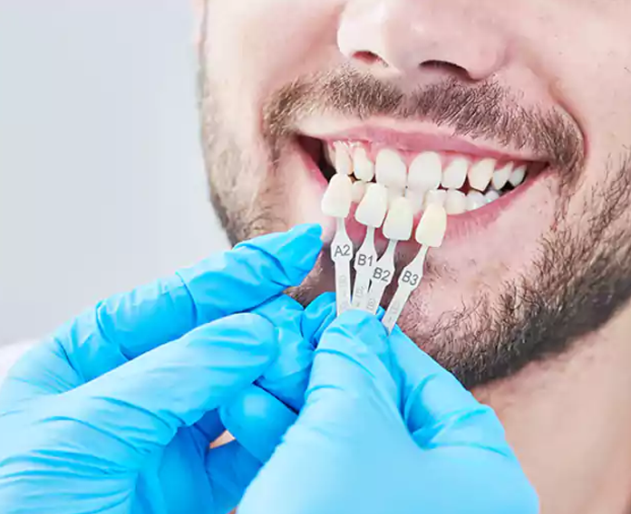 Ideal Candidates for Composite Bonding