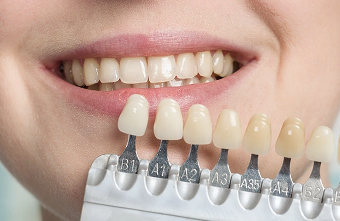 Factors that influence the lifespan of dental bonding on teeth