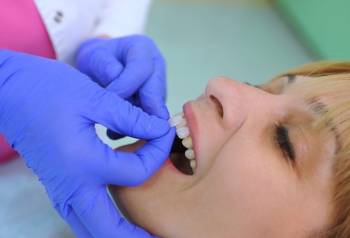 What is the procedure for composite veneers?