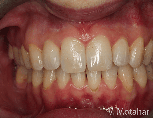 Invisalign Full treatment after - Bayswater Dental Clinic