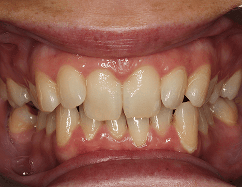 Invisalign Full treatment before - Bayswater Dental Clinic