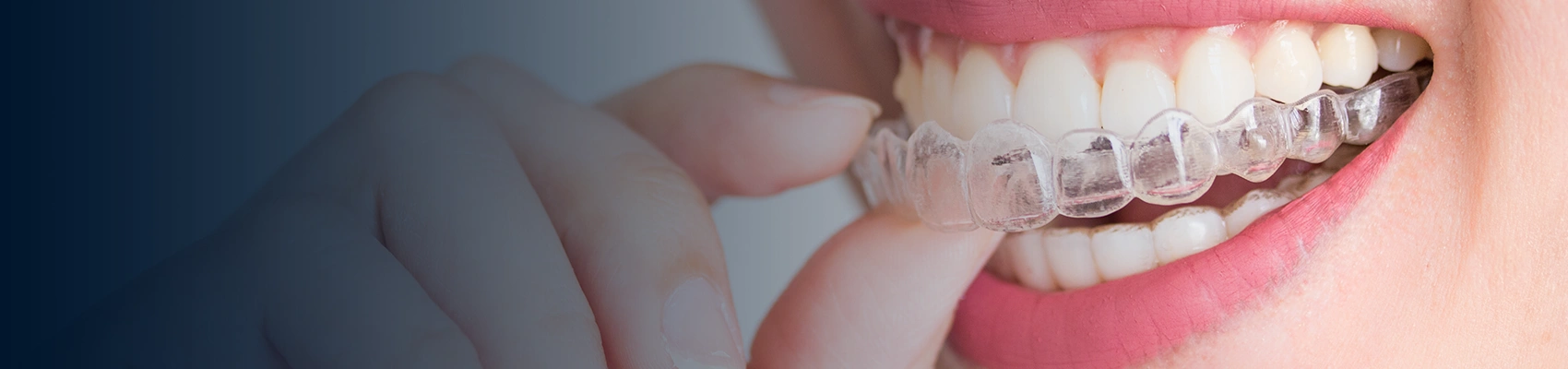 Invisalign Moderate at Bayswater Dental Clinic