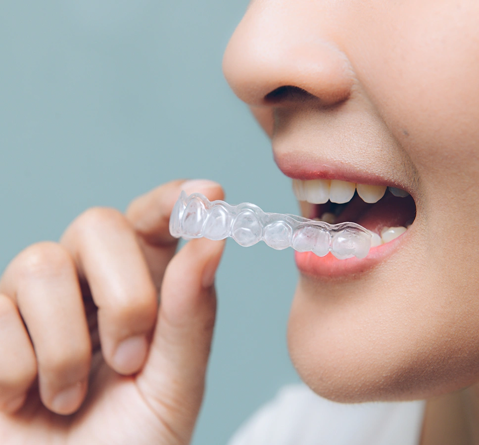 What Invisalign treats and advantages over metal braces