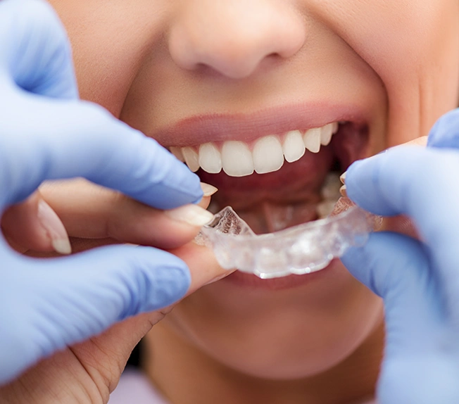 Invisible Braces for adults