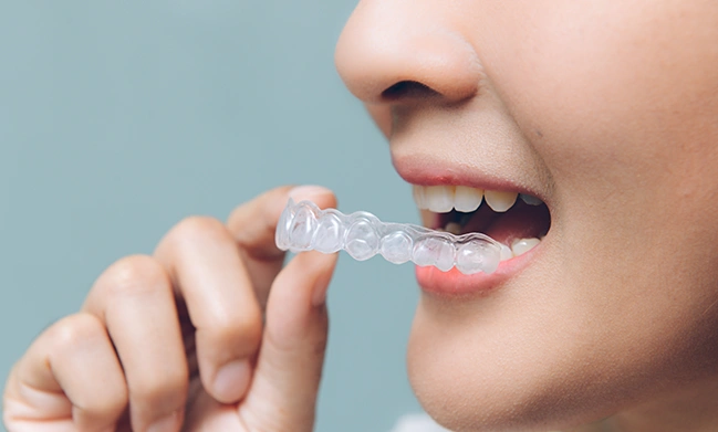 How does Invisalign, the Invisible Clear Plastic Brace System work?