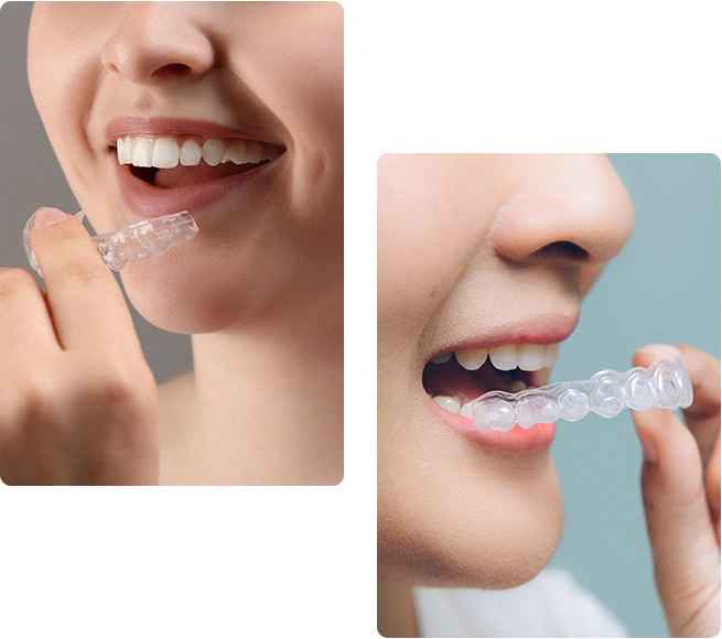 Invisible Removable Aligner - Bayswater Dental Clinic