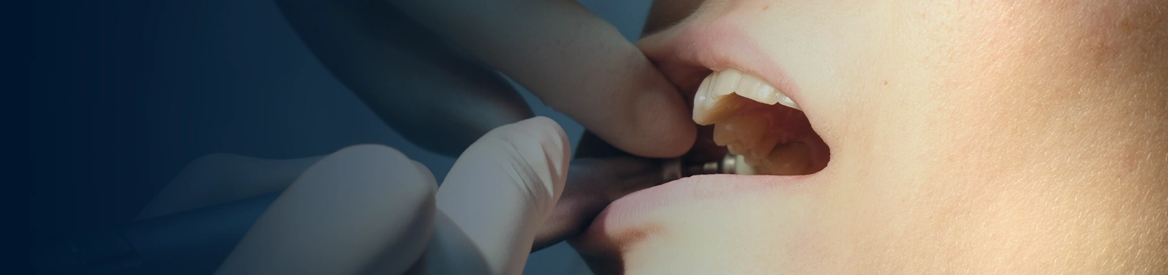 Laser gum bleaching at Bayswater Dental Clinic banner image