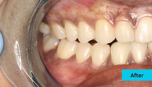 Laser Gum bleaching case-1 after image - Bayswater Dental Clinic