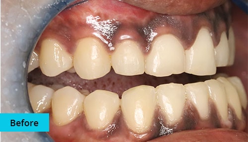 Laser Gum bleaching case-1 before image - Bayswater Dental Clinic