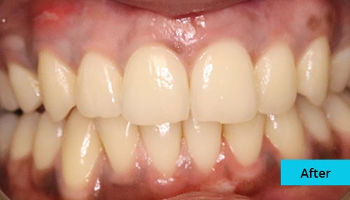 Laser Gum bleaching case-2 after image - Bayswater Dental Clinic