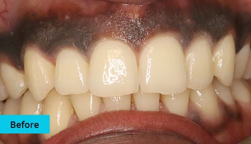 Laser Gum bleaching case-2 before image - Bayswater Dental Clinic